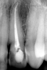Properly filled root canals. The lateral incisors have per one root canal.