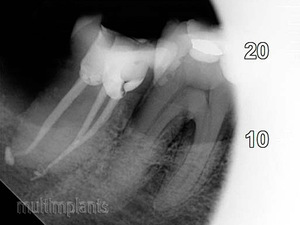 Properly filled root canals. Generally, the mandibular large molars have per 3 root canals, positioned in 2 roots– 1 in the back root and 2 in the front root.   