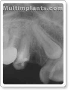 Retained "canine" tooth - a threat to the incisors. You can see the crown presses against the root of the side incisor.