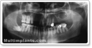 Classically horizontal retained 8-th tooth.