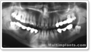 Another case of multiple retained teeth. The lower right has a large  follicular cyst.  