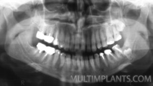 Uniquely low located retained 8-th  tooth. In such cases, surgery has  a very high risk of fracturing the  lower jaw. 