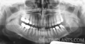 A control X-ray showing the alveolus of a successfully extracted retained 8-th tooth without fracturing the jaw.     