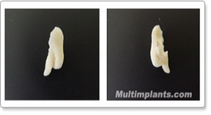 These photos show the successfully removed retained tooth from the previous x-ray. 