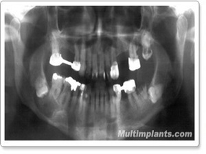 A unique case of a retained lower 8-th tooth, pointing in the opposite direction and developing a huge follicular cyst.