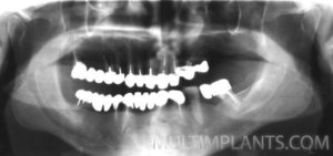 Super unique case of the retained canine tooth. Its crown crosses the upper left central incisor, and the tip of the root rests in orbit.