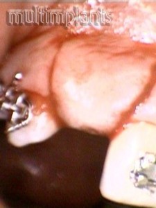 Surgical incision from the lip.