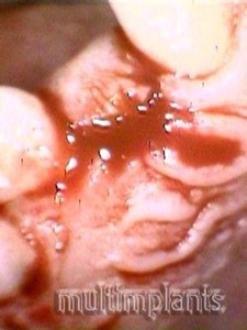 Surgical incision from the palate.