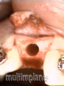 The 'bed' of the implant in the bone.