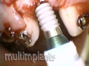 Placing the implant.