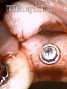 The implant after removing the Screwdriver.