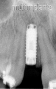 X-ray – we inserted the implant correctly.