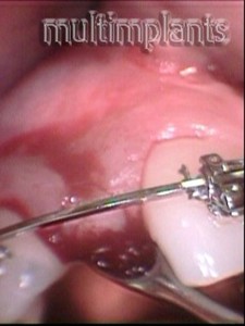 Removal of a part of the gum over the Implant.