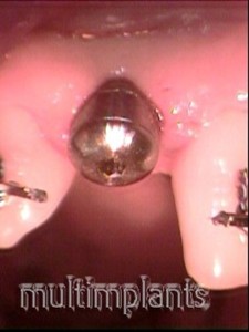 The healing screw in the patient's mouth.