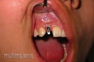 The abutment in the mouth of the patient.