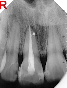 Of interest are the cases with horizontal canals, in which if the canal filling is not condensed, the tooth will not be cured