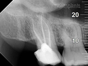 Properly filled root canals. Generally, the maxillary large molars have 3 root canals.