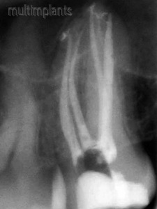 Properly filled root canals. There are some cases of 4 and more root canals