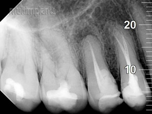 Properly filled root canals. The maxillary small molars have per 2 root canals.