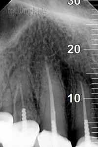 Properly filled root canals. The maxillary canines have per one root canal.