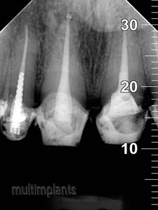 Properly filled root canals. Maxillary central incisors have per one root.