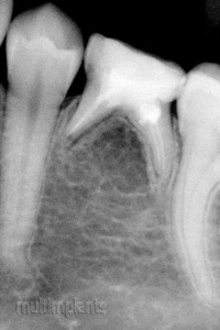 Каналите на млечните зъби по принцип се лекуват с ампутация. Понякога се налага да бъдат запълвани. Добре запълнени канали на млечен зъб.