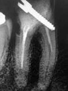 Improperly filled up maxillary large molar and a dental pin also not properly positioned.