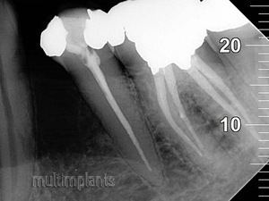 Properly filled root canals. Sometimes, the mandibular large molars may have 2 canals in the back root, thus they become 4 in total.