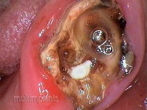 A tooth decayed down to the level of the gingiva with properly cured canals.