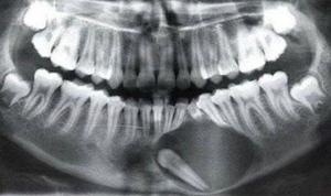 A huge follicular cyst or a cystic adamantinoma!?