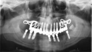 Checkup x-ray – treatment stage