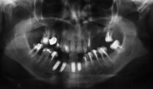 Checkup x-ray – treatment stage