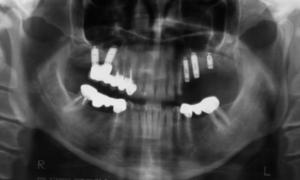 Checkup x-ray – treatment stage