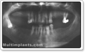  Retained lower right 8-th tooth. Unique placement. The tooth’s crown is down