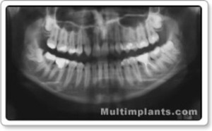 Друг случай, илюстриращ  множествени ретинирани зъби у един и същ пациент.