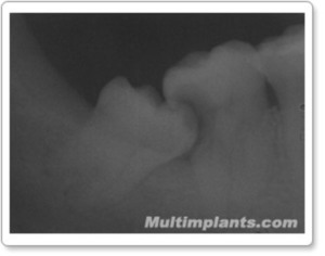 Resorption of the crown of the 47  tooth that reached the pulp