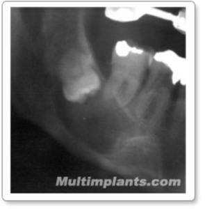 На малката снимка – отрязък от участъка от предишната снимка със зъба и кистата. Съществува реална опасност от спонтанно счупване на долната челюст.
