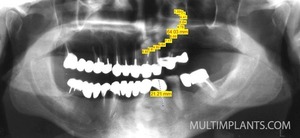 The software measured 64.03 mm in length. For  greater accuracy, we also measured the length of the  lower premolar - 21.21 mm. The most common length  of these tooth is about 20 mm.