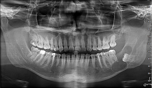 Uniquely located lower retained sage with a huge  follicular cyst, thinning to a degree of spontaneous  fracture of the jaw. Even above the crown there is  a cracked area. 