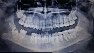 'Kissing' retained 'wisdom' teeth