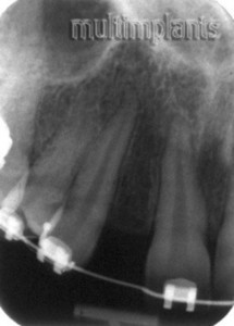 Рентгеновата снимка - достатъчно за имплантиране разстояние