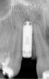 Рентгенов контрол - имплантатът е поставен екзактно