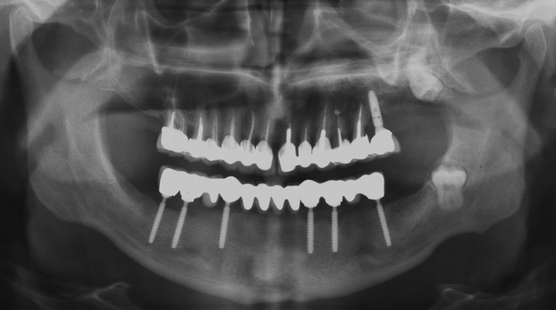 [/userfiles/files/01-cortico-basal-implants.jpg]