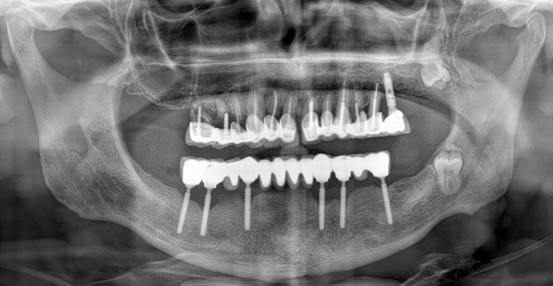 [/userfiles/files/02-cortico-basal-implants.jpg]