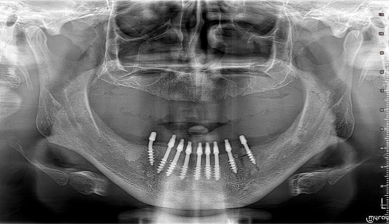 [/userfiles/files/03-cortico-basal-implants.jpg]
