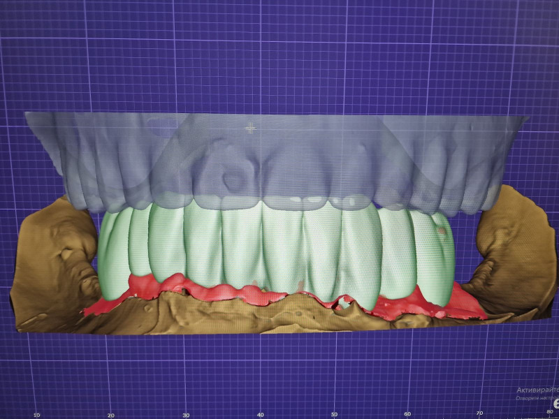 [/userfiles/files/05-cortico-basal-implants.jpg]