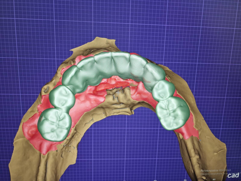 [/userfiles/files/06-cortico-basal-implants.jpg]
