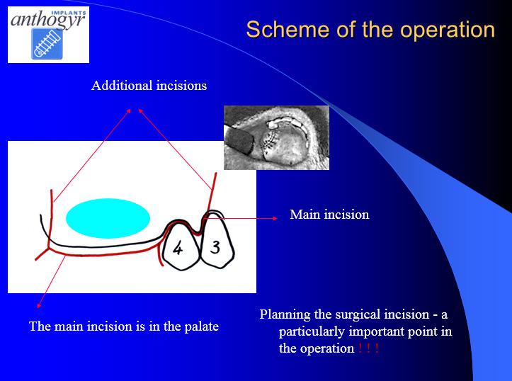 [/userfiles/files/Bone-Implantation-10.jpg]