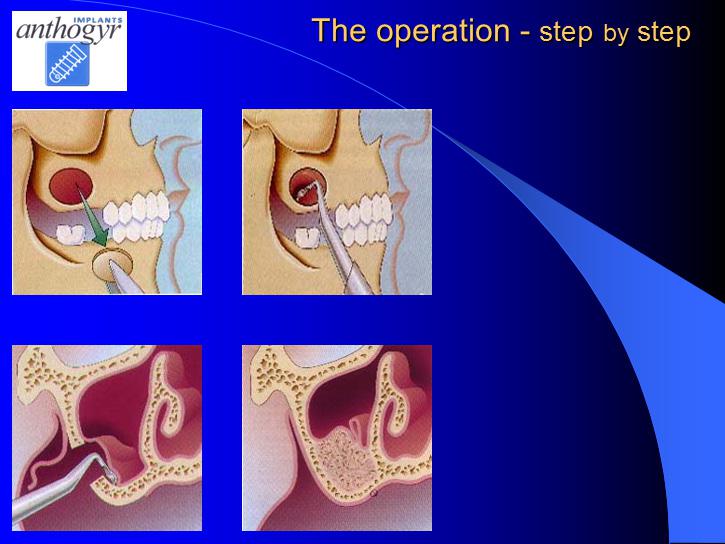 [/userfiles/files/Bone-Implantation-11.jpg]