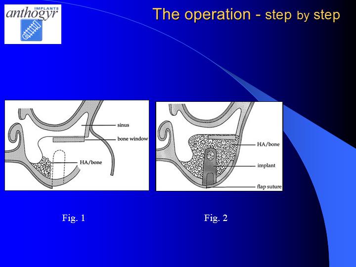 [/userfiles/files/Bone-Implantation-12.jpg]